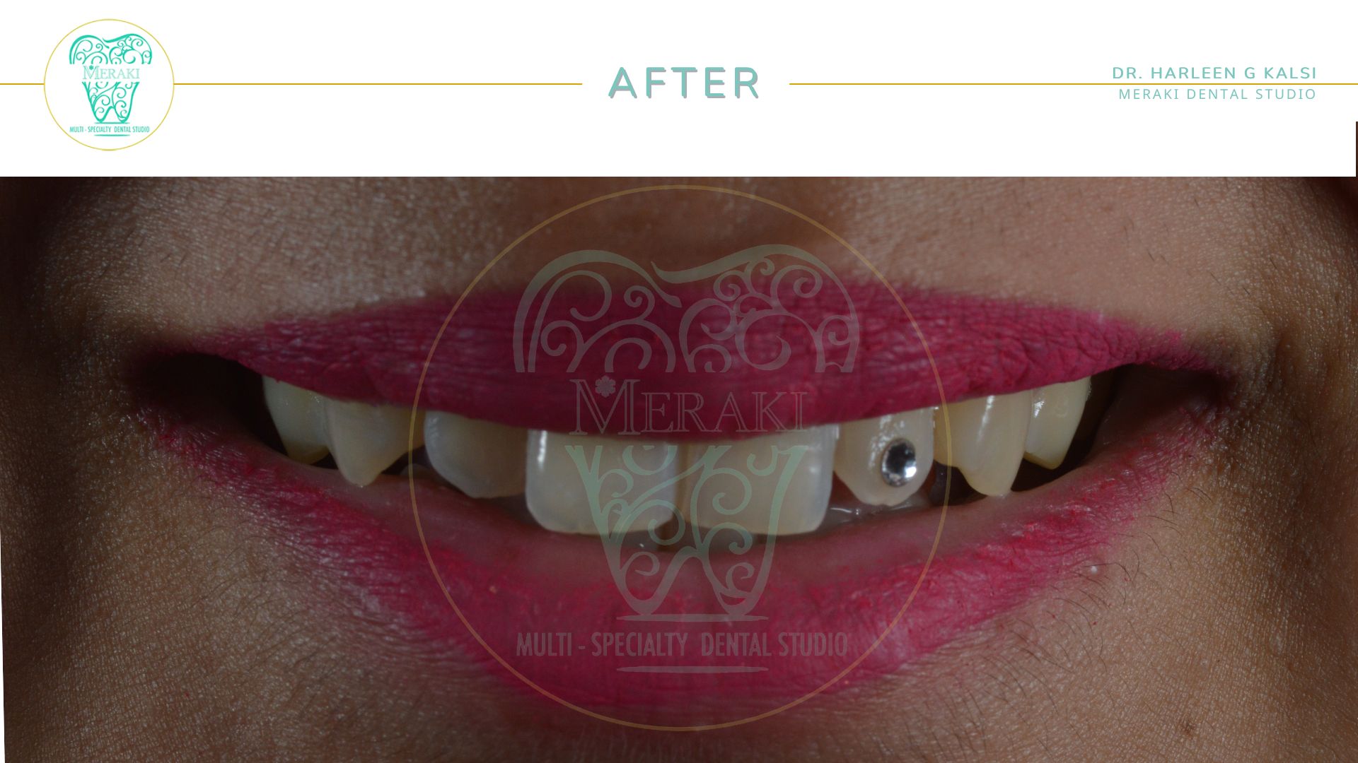 dental-jewellery-after